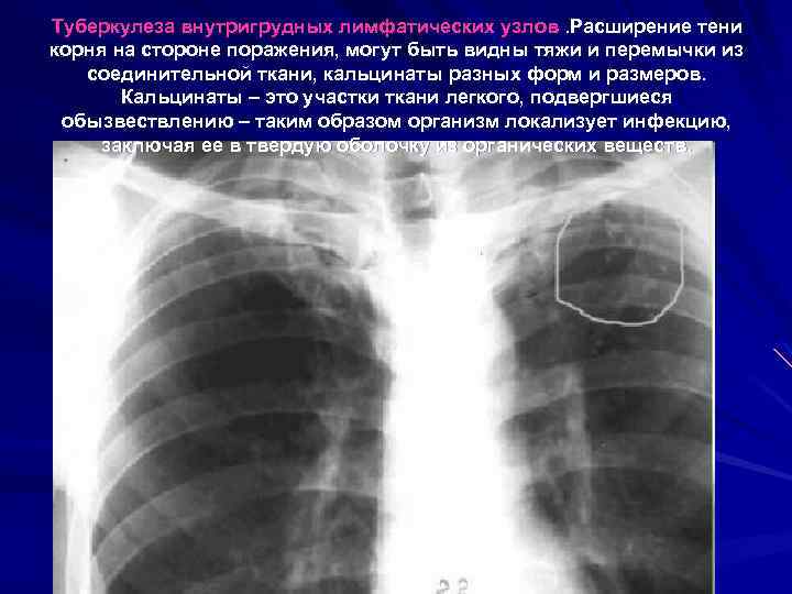 Туберкулеза внутригрудных лимфатических узлов. Расширение тени корня на стороне поражения, могут быть видны тяжи