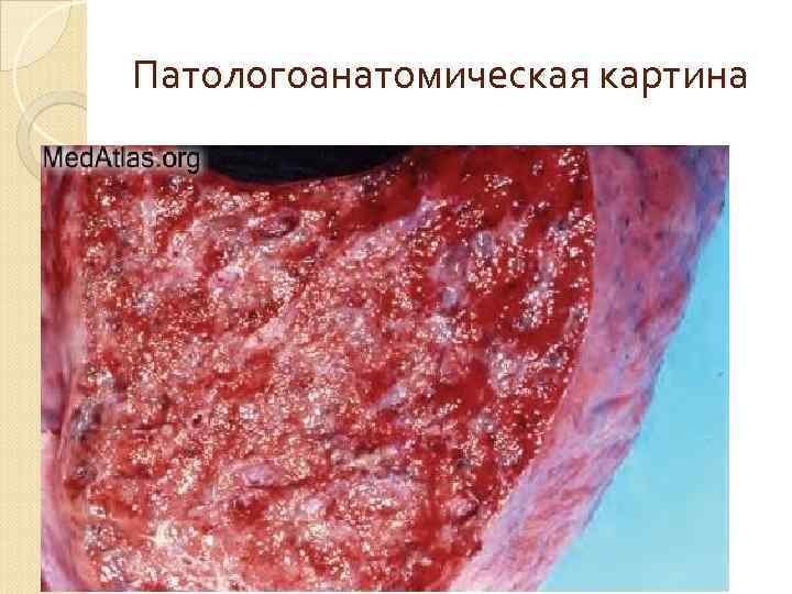Патологоанатомическая картина 