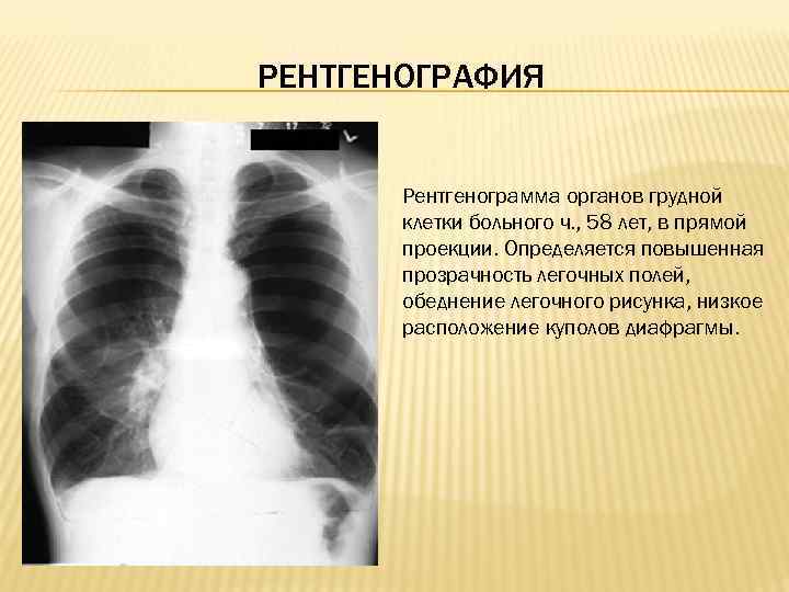 РЕНТГЕНОГРАФИЯ Рентгенограмма органов грудной клетки больного ч. , 58 лет, в прямой проекции. Определяется