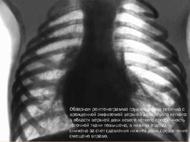 Обзорная рентгенограмма грудной клетки ребенка с врожденной эмфиземой верхней доли левого легкого: в области