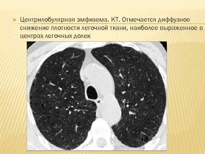  Центрилобулярная эмфизема. КТ. Отмечается диффузное снижение плотности легочной ткани, наиболее выраженное в центрах