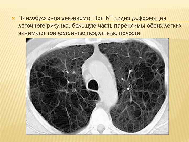  Панлобулярная эмфизема. При КТ видна деформация легочного рисунка, большую часть паренхимы обоих легких