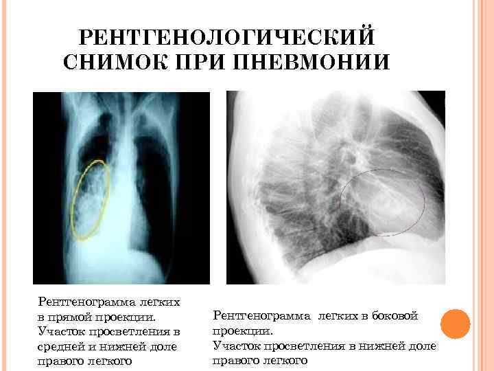 РЕНТГЕНОЛОГИЧЕСКИЙ СНИМОК ПРИ ПНЕВМОНИИ Рентгенограмма легких в прямой проекции. Участок просветления в средней и