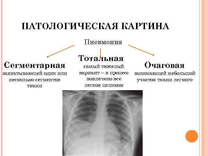 ПАТОЛОГИЧЕСКАЯ КАРТИНА Пневмония Сегментарная захватывающей один или несколько сегментов ткани Тотальная самый тяжелый Очаговая