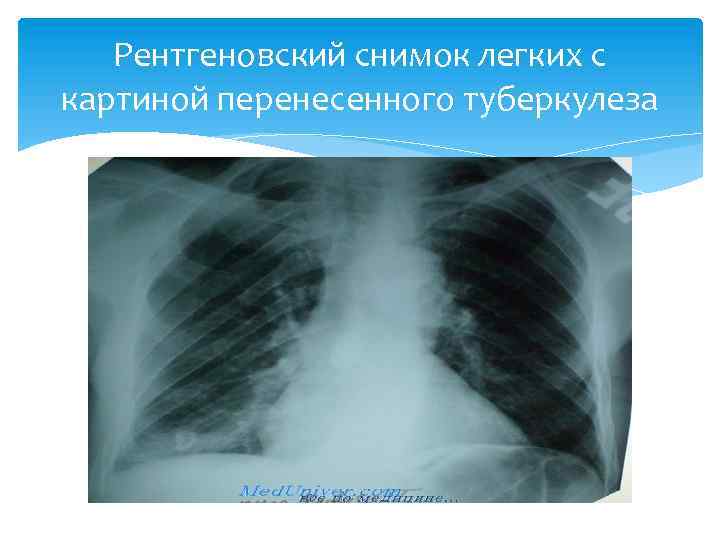 Рентгеновский снимок легких с картиной перенесенного туберкулеза 