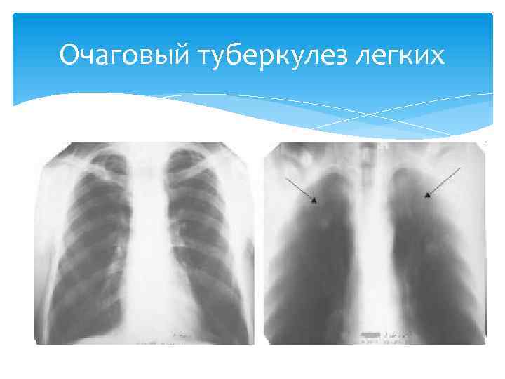 Очаговый туберкулез легких 