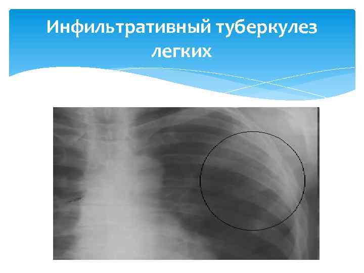 Инфильтративный туберкулез легких 