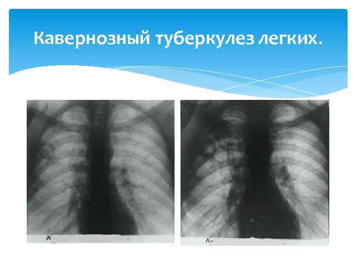 Кавернозный туберкулез легких. 