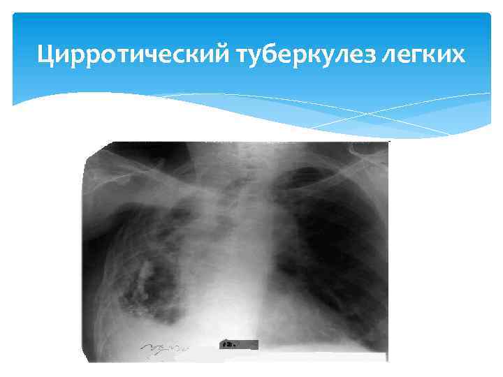 Цирротический туберкулез легких 