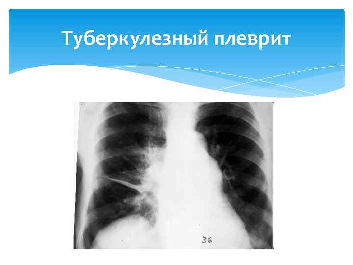 Туберкулезный плеврит 