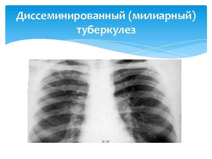 Диссеминированный (милиарный) туберкулез 