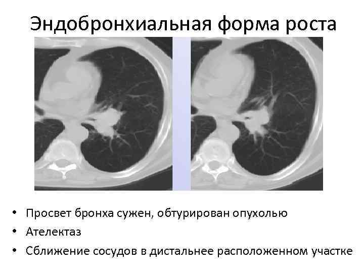 Эндобронхиальная форма роста • Просвет бронха сужен, обтурирован опухолью • Ателектаз • Сближение сосудов