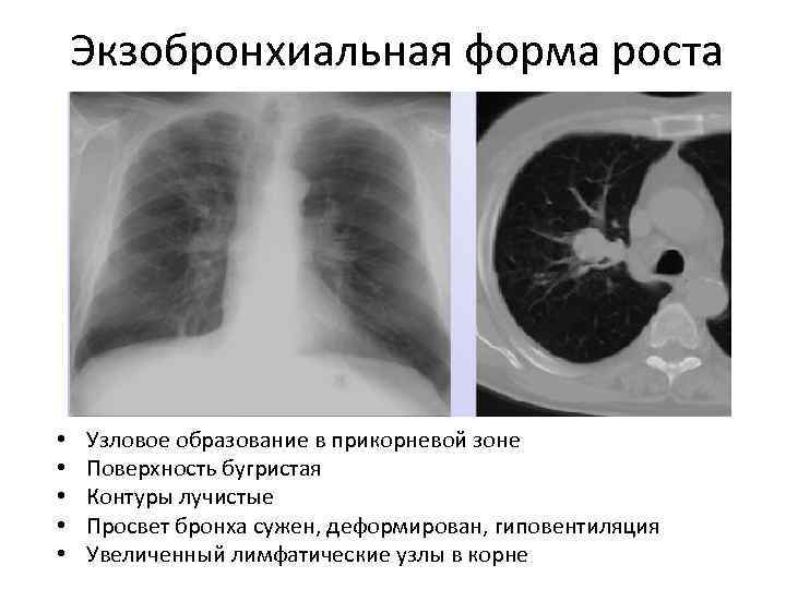 Экзобронхиальная форма роста • • • Узловое образование в прикорневой зоне Поверхность бугристая Контуры