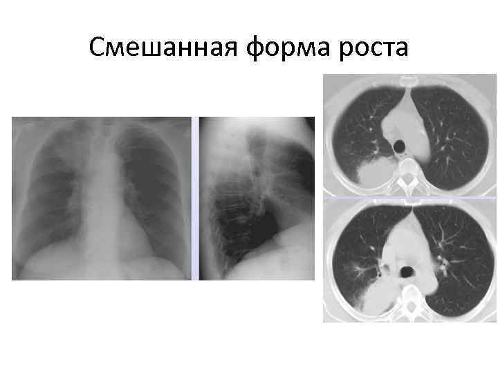 Смешанная форма роста 