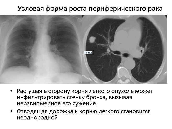 Узловая форма роста периферического рака • Растущая в сторону корня легкого опухоль может инфильтрировать