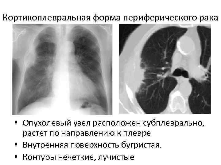 Кортикоплевральная форма периферического рака • Опухолевый узел расположен субплеврально, растет по направлению к плевре