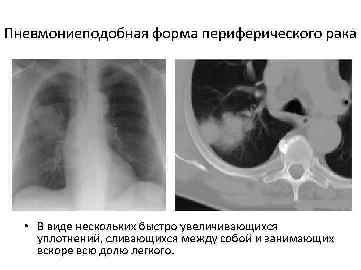 Пневмониеподобная форма периферического рака • В виде нескольких быстро увеличивающихся уплотнений, сливающихся между собой
