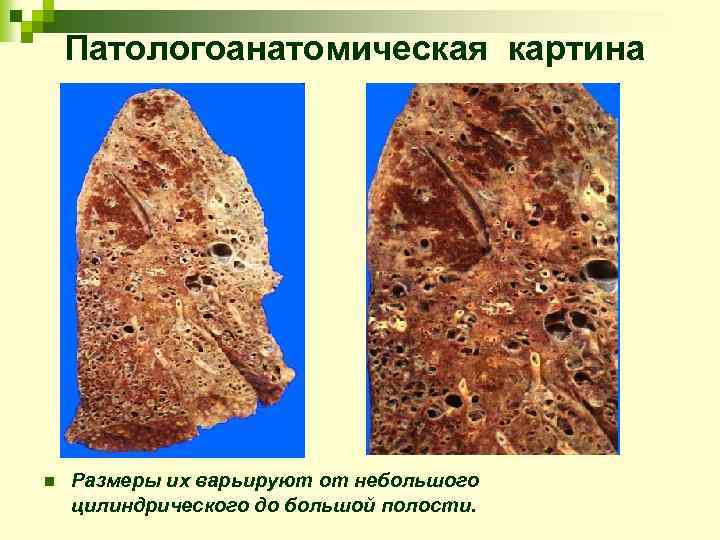 Патологоанатомическая картина n Размеры их варьируют от небольшого цилиндрического до большой полости. 