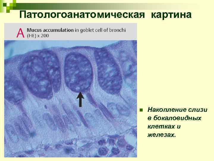 Патологоанатомическая картина n Накопление слизи в бокаловидных клетках и железах. 