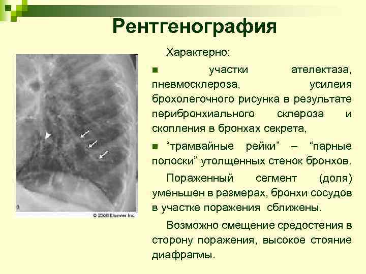 Рентгенография Характерно: участки ателектаза, пневмосклероза, усилеия брохолегочного рисунка в результате перибронхиального склероза и скопления