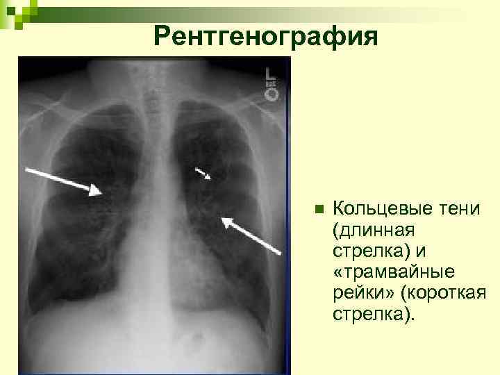 Рентгенография n Кольцевые тени (длинная стрелка) и «трамвайные рейки» (короткая стрелка). 