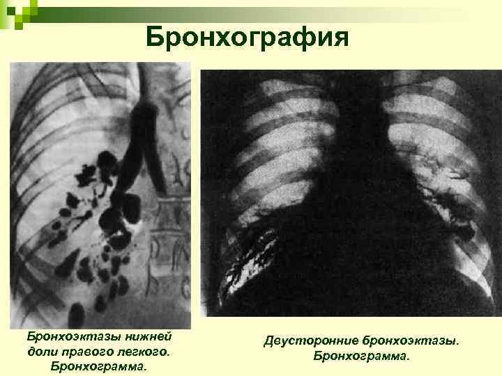 Бронхография Бронхоэктазы нижней доли правого легкого. Бронхограмма. Двусторонние бронхоэктазы. Бронхограмма. 