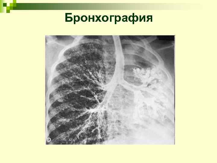 Бронхография 