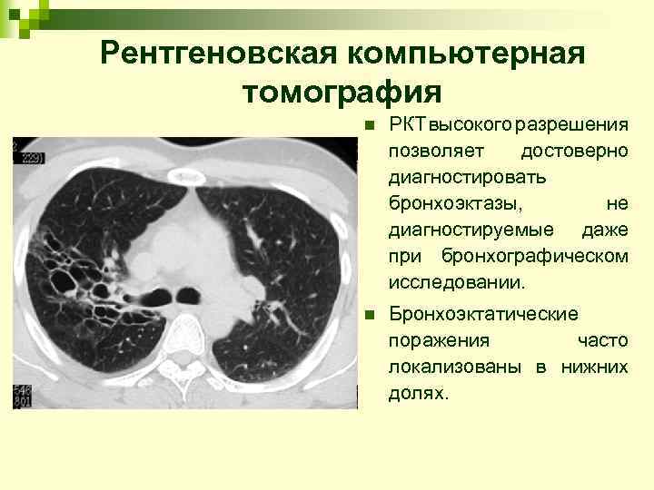 Рентгеновская компьютерная томография n РКТ высокого разрешения позволяет достоверно диагностировать бронхоэктазы, не диагностируемые даже