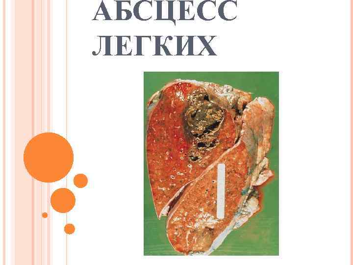 АБСЦЕСС ЛЕГКИХ 