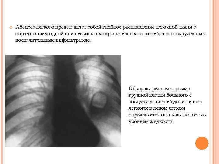  Абсцесс легкого представляет собой гнойное расплавление легочной ткани с образованием одной или нескольких