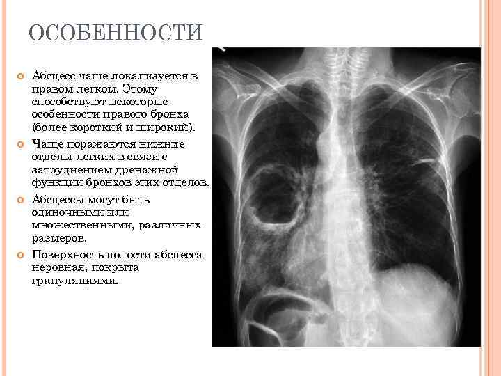 ОСОБЕННОСТИ Абсцесс чаще локализуется в правом легком. Этому способствуют некоторые особенности правого бронха (более