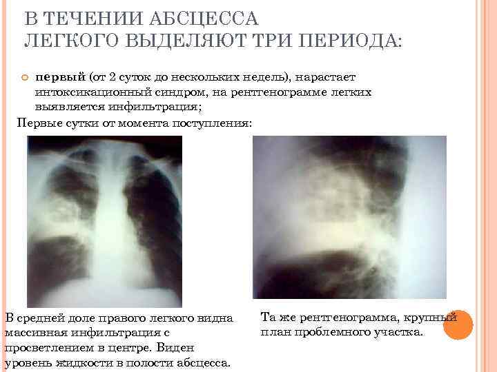 В ТЕЧЕНИИ АБСЦЕССА ЛЕГКОГО ВЫДЕЛЯЮТ ТРИ ПЕРИОДА: первый (от 2 суток до нескольких недель),