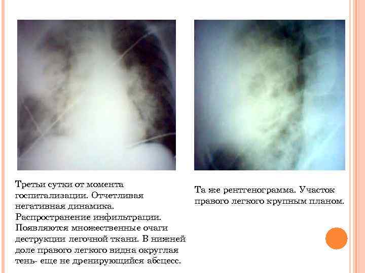 Третьи сутки от момента Та же рентгенограмма. Участок госпитализации. Отчетливая правого легкого крупным планом.