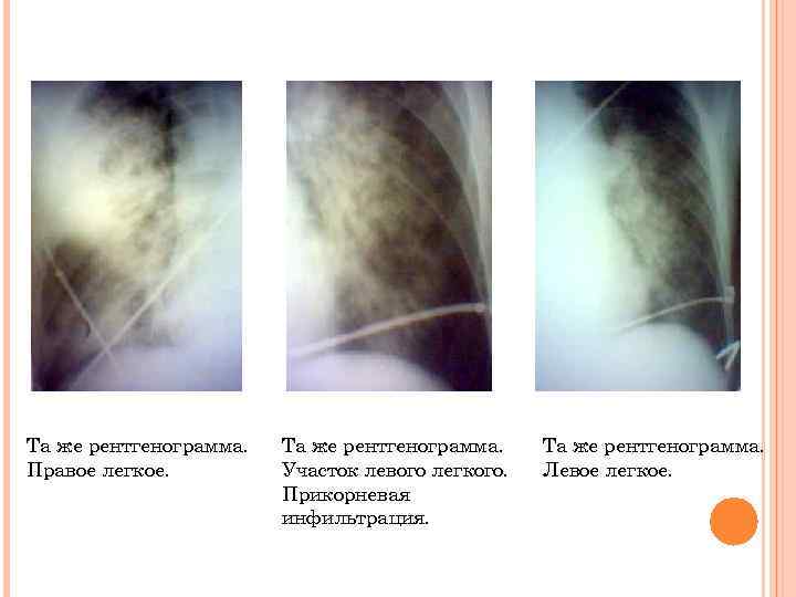 Та же рентгенограмма. Правое легкое. Та же рентгенограмма. Участок левого легкого. Прикорневая инфильтрация. Та