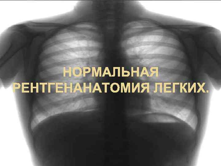 НОРМАЛЬНАЯ РЕНТГЕНАНАТОМИЯ ЛЕГКИХ. 
