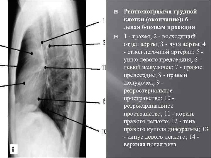 На компьютерной томограмме органов грудной клетки трахея определяется как