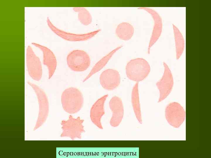 Серповидные эритроциты 