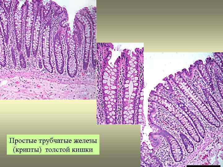 Гиперплазированный железистый эпителий на фоне крови