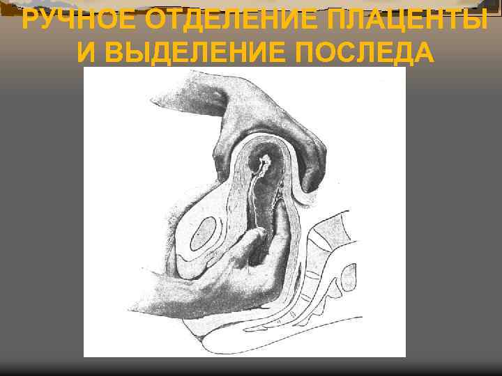 РУЧНОЕ ОТДЕЛЕНИЕ ПЛАЦЕНТЫ И ВЫДЕЛЕНИЕ ПОСЛЕДА 