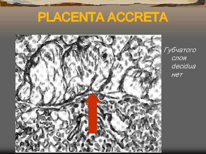 PLACENTA ACCRETA Губчатого слоя decidua нет 