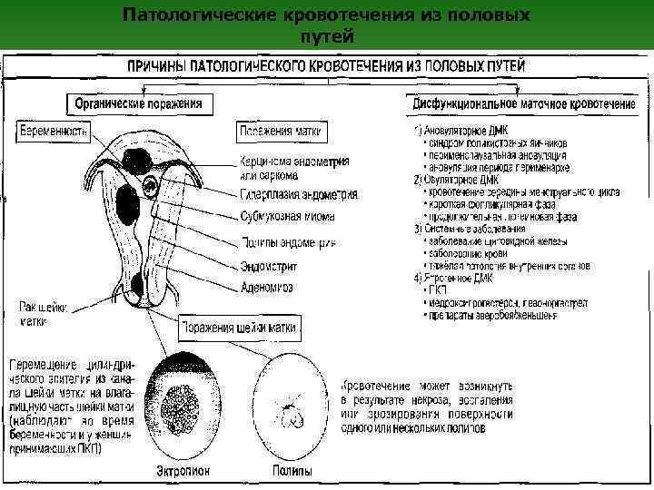 Патологические кровотечения из половых путей 