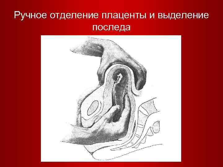 Ручное отделение плаценты и выделение последа 