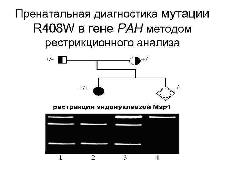 Пренатальная диагностика мутации R 408 W в гене PAH методом рестрикционного анализа 