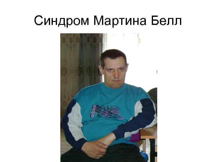 Синдром Мартина Белл 