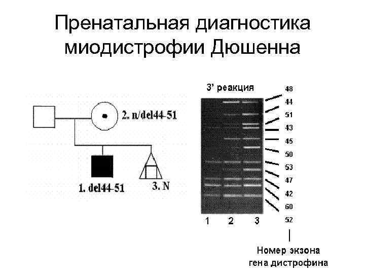Пренатальная диагностика миодистрофии Дюшенна 