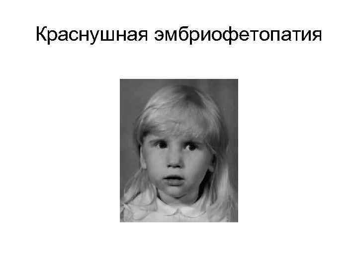 Краснушная эмбриофетопатия 