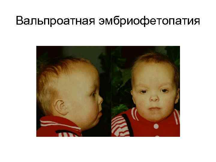 Вальпроатная эмбриофетопатия 