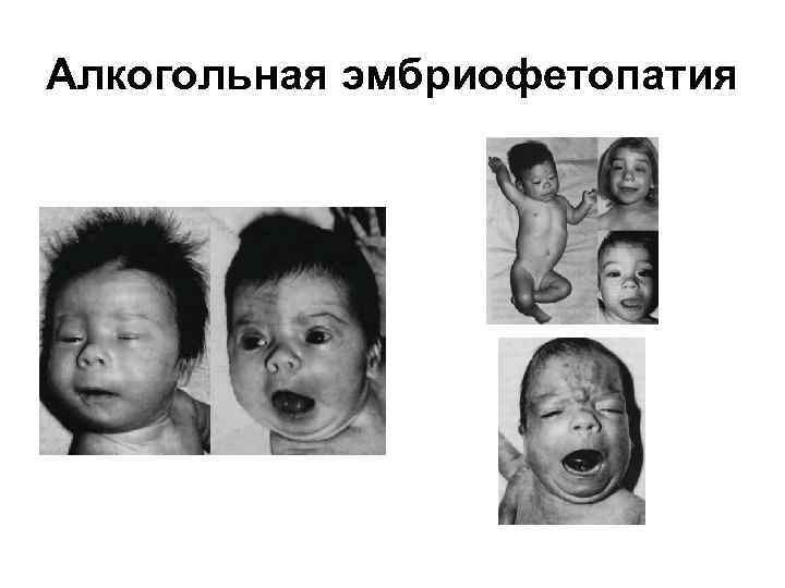 Алкогольная эмбриофетопатия 