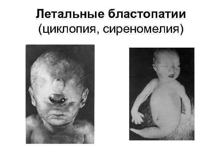 Летальные бластопатии (циклопия, сиреномелия) 