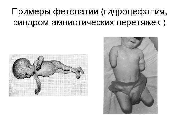 Примеры фетопатии (гидроцефалия, синдром амниотических перетяжек ) 